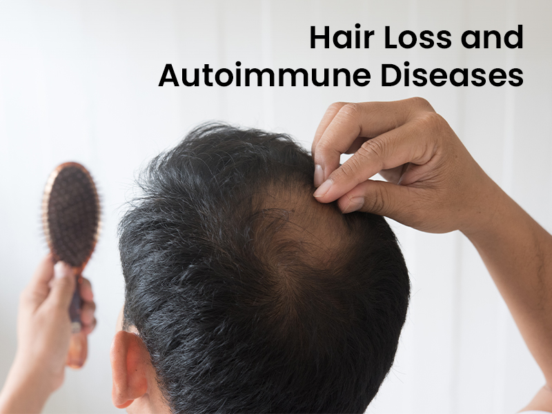 Hair Loss and Autoimmune Diseases